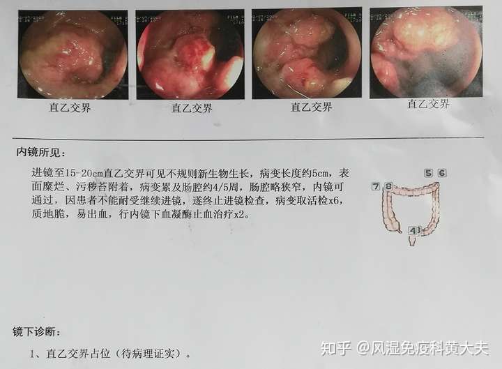 结肠和直肠的位置 结肠和直肠到底在哪里,请看下面这张图 来看看