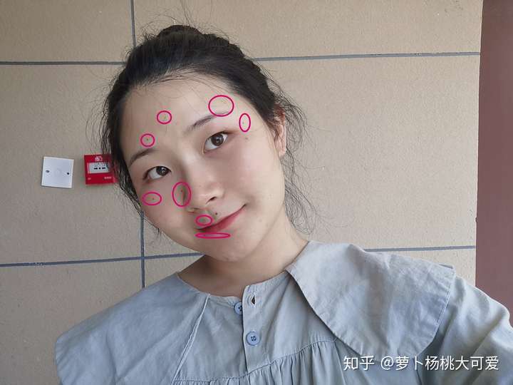 去医院做激光去痣需要多少钱