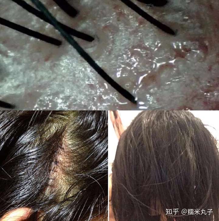 油腻腻地趴在头顶,一抓一大把头屑,简直严重破坏形象!