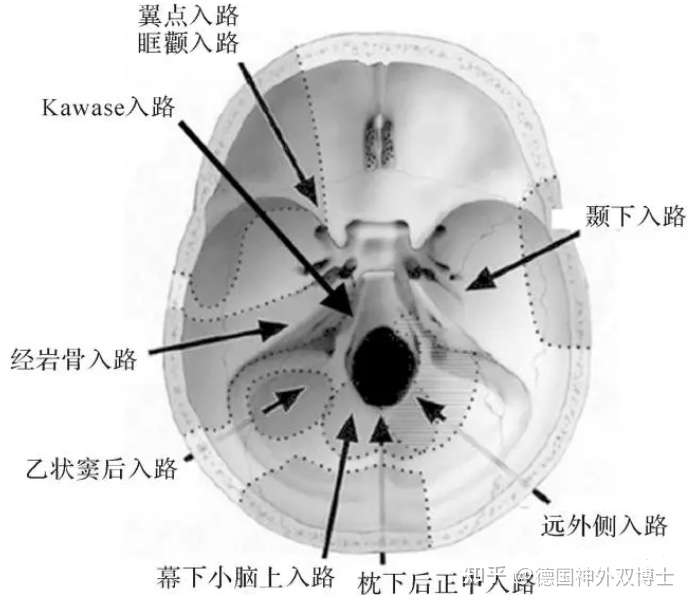 颞下经天幕入路 4,岩前入路 5,枕下经膜髓帆入路 6,后正中小脑上天幕
