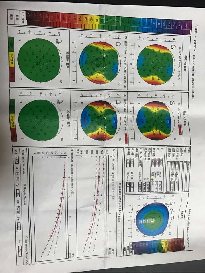 请大神看一下角膜地形图,是不是不规则散光,晚上看东西上下重影?