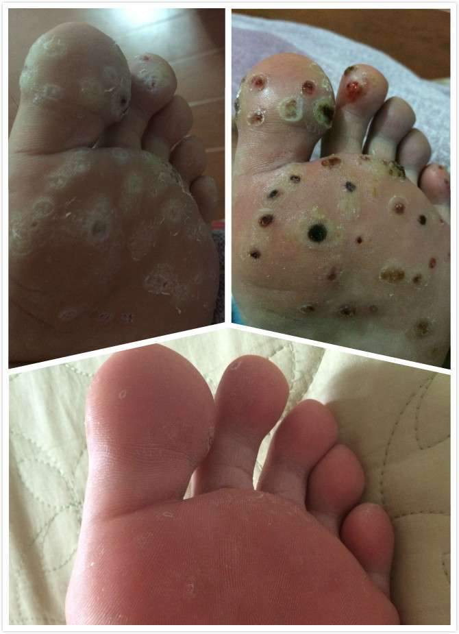 用醋泡脚能治愈跖疣?