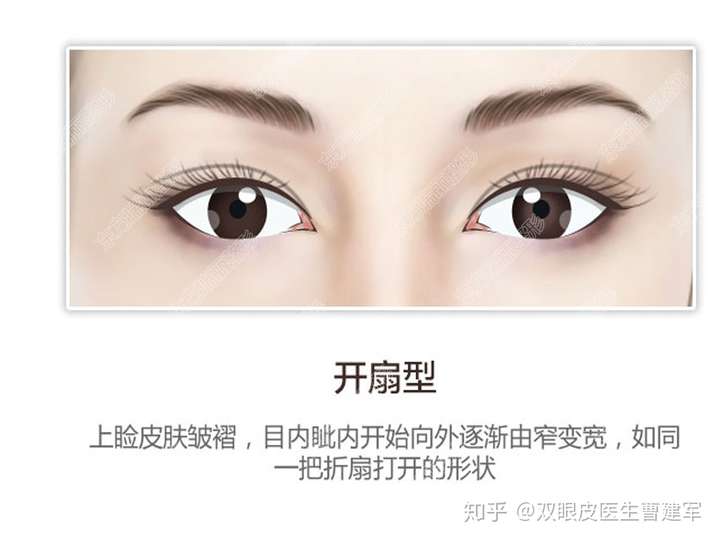 割双眼皮可以自己选择双眼皮的形状吗?