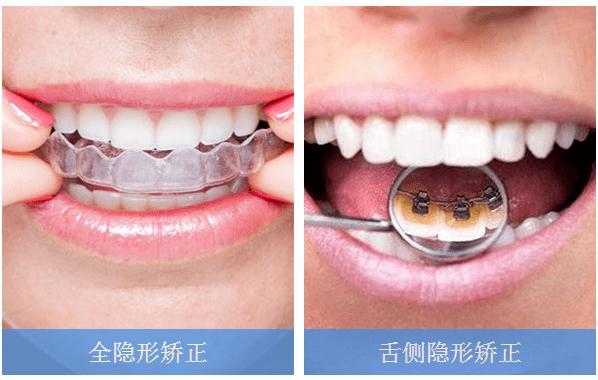 上海有好一点的地方做牙齿隐形矫正吗?
