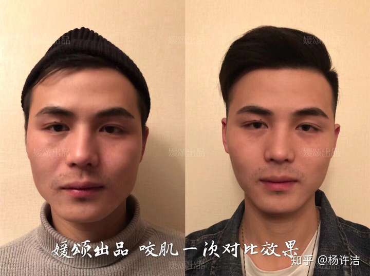 我的咬肌过大,想去微整,但家长以男孩子搞什么飞机为由,拒绝我的申请