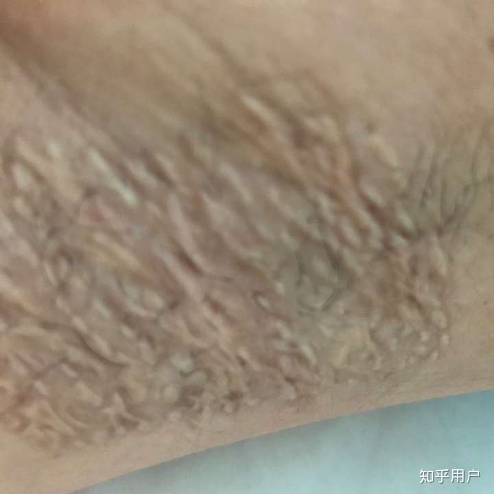 做腋下大汗腺切除手术是什么体验?