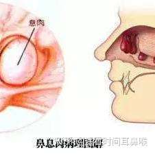 鼻息肉日常生活如何预防