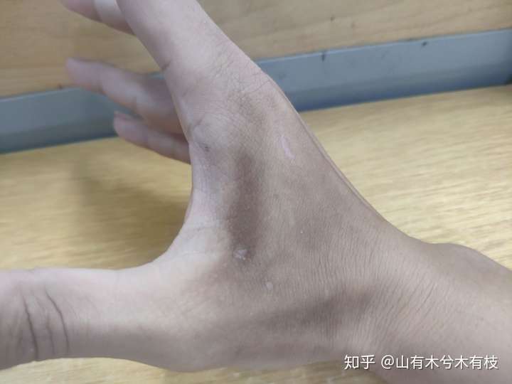 手上皮肤有几块黑的是咋回事,擦不掉,也不蜕皮?