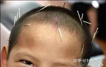 换句话讲,中风后针灸到底是哪种针灸方式取得了疗效?