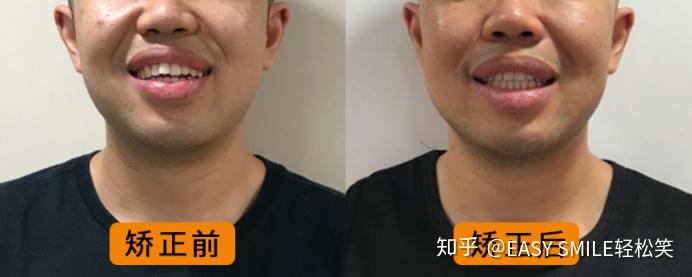 牙齿矫正对于脸型的改变到底能有多大