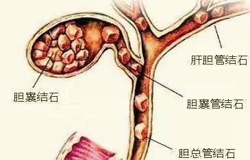 胆囊结石需要手术治疗吗