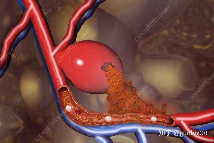 一生中最严重的头痛—"动脉瘤性蛛网膜下腔出血"