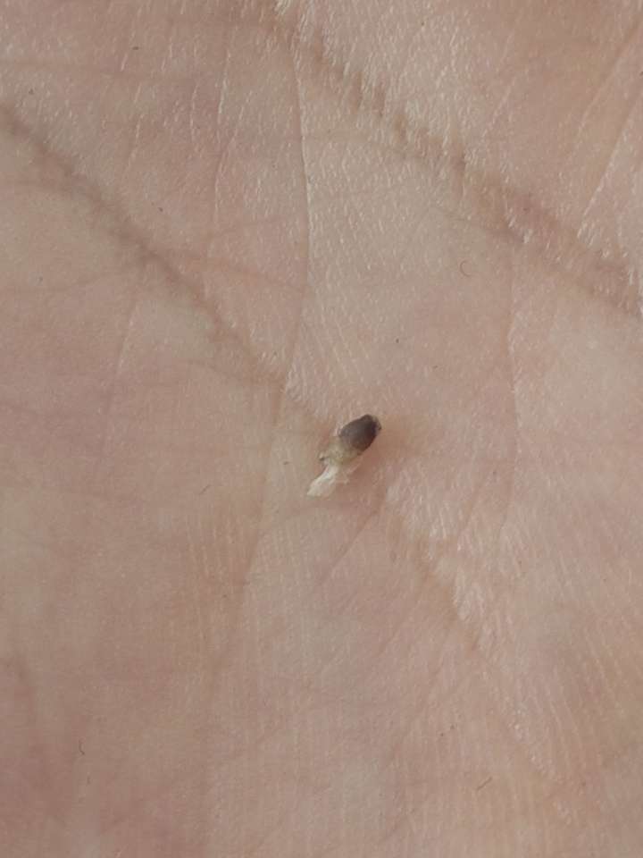 史上最大的黑头有多大?