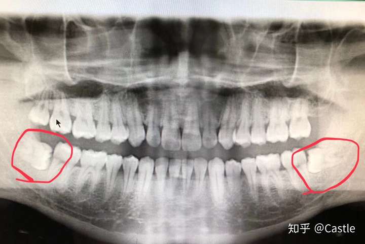 拔智齿有多痛