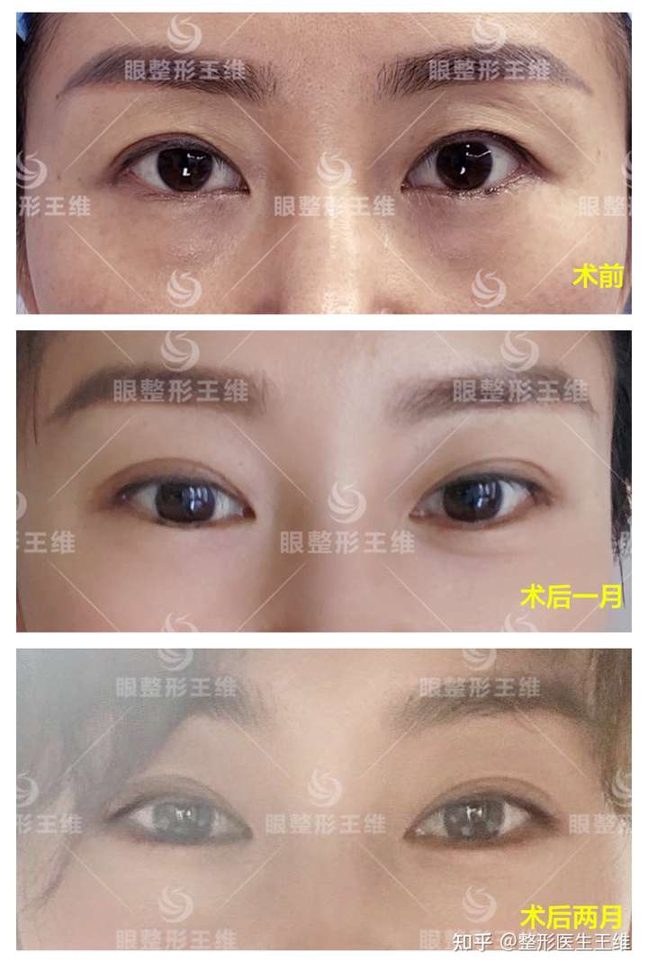 双眼皮做太窄5mm会成内双吗?