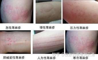 荨麻疹是因为免疫力太低嘛