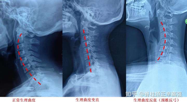 颈椎生理曲度消失到底要怎么治