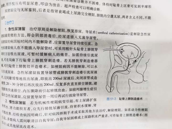 什么是急性尿潴留?