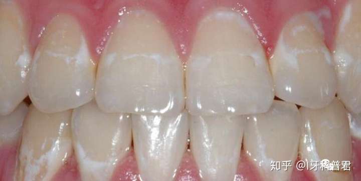 牙齿矫正会导致牙釉质脱矿?该怎么解决?