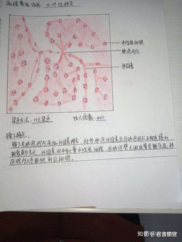 红蓝铅笔大叶性肺炎图怎么画?