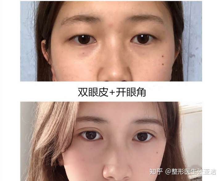 为什么很多肿泡眼的小仙女都想做双眼皮呢?