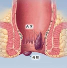 痔疮:一般肛门较少有分泌物,当内痔严重脱出时,有分泌物存在,但分泌