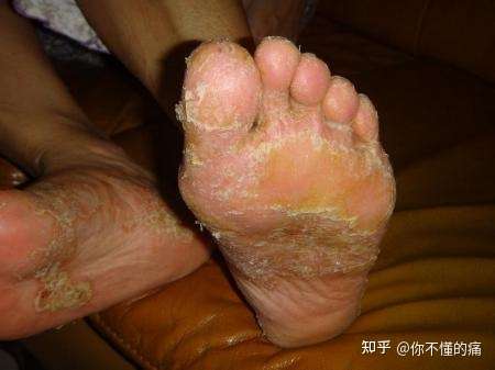 脚气有什么症状?