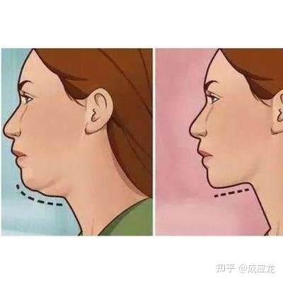 为什么很瘦但是也有很明显的双下巴?