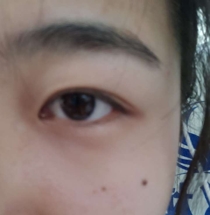 请问这是泪痣吗?应该点掉吗?在左眼,多谢帮助?