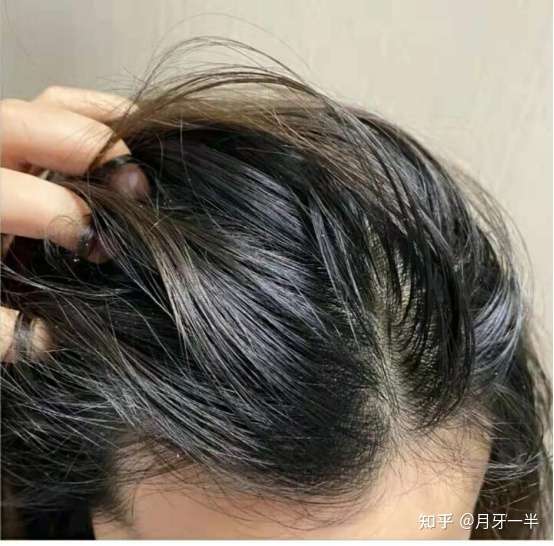 头发容易油还很难闻怎么办(头发油还比较难闻是怎么回事)