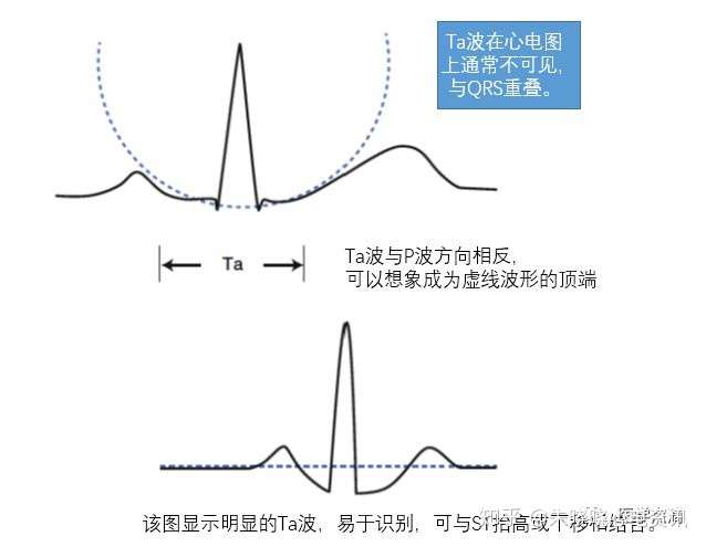 心电图各波段的命名和定义你掌握了吗