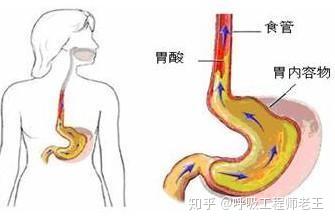 什么是胃食管反流病