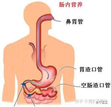 老年胃癌患者术后早期肠内联合肠外营养的支持治疗