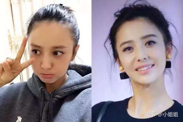女性发际线后移一定要看