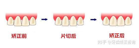 牙齿矫正选择拔牙还是片切方案