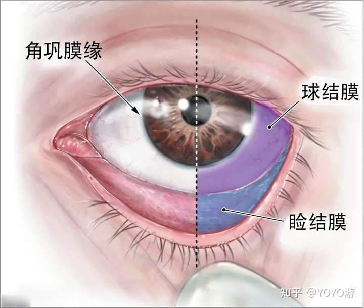 过敏性结膜炎这个病严重吗?有什么好的治疗方法?