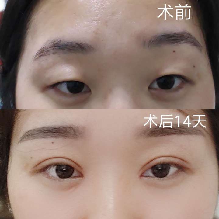 内眦赘皮,通过双眼皮 开内眼角 上睑提肌全方位改善,术前术后的对比