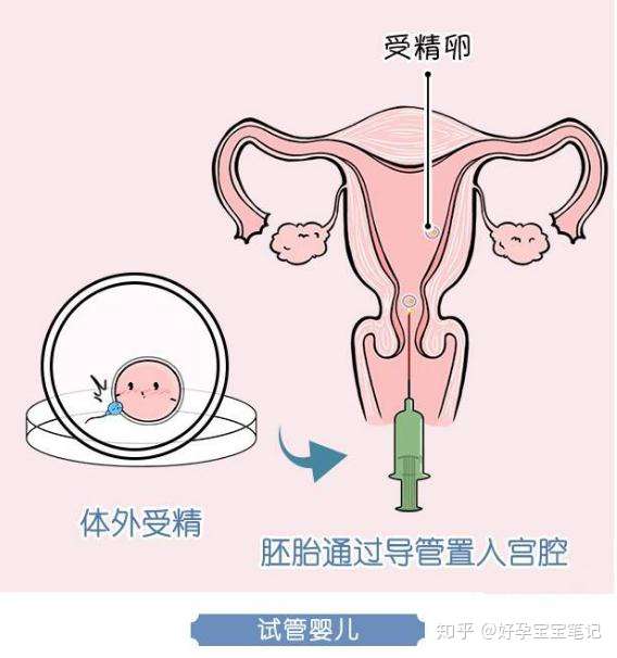 人工授精和试管婴儿适应症,费用,成功率的对比