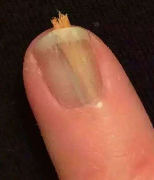 把一根牙签插在大脚趾的指甲缝里对着墙用力一踢