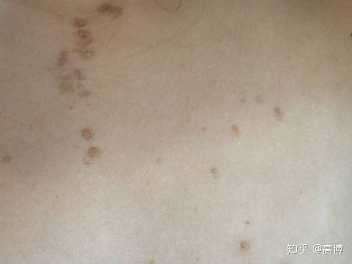 怎么治疗扁平疣