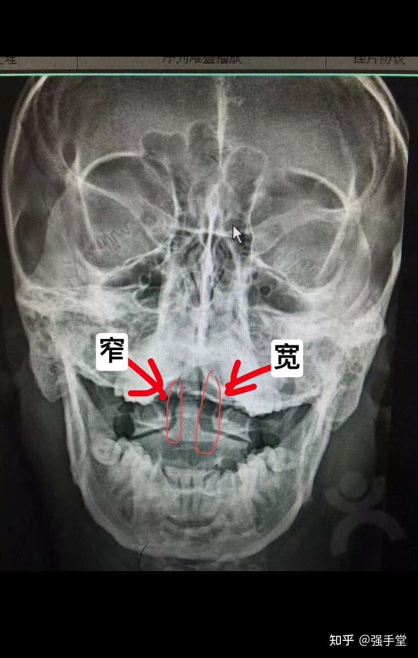 强手堂 的想法: 颈椎寰枢关节半脱位就是这看片子,这