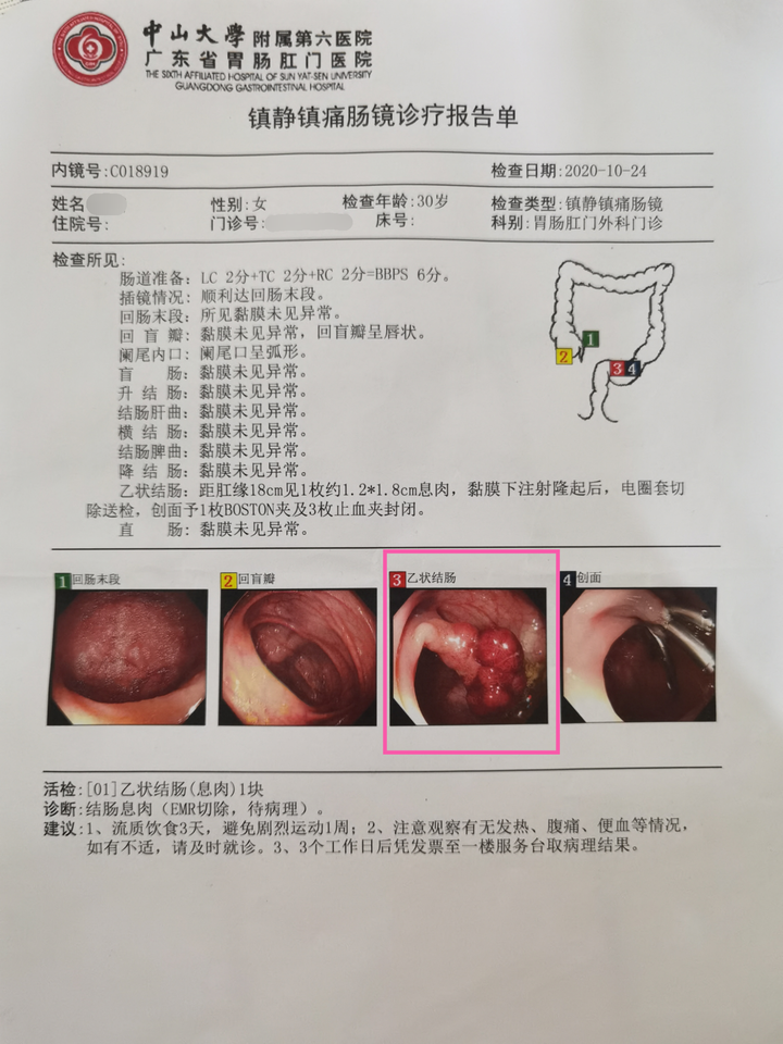 做普通肠镜是什么感觉?