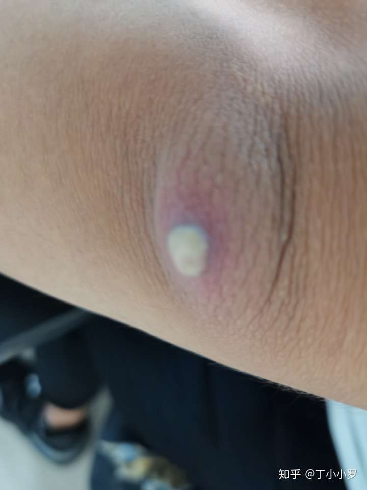 一个火疖子能大到什么地步?
