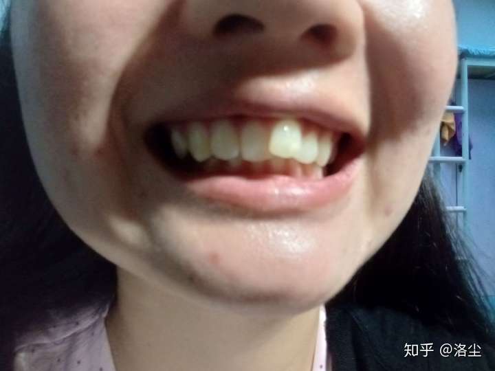 有人和我一样的门牙吗?你们整牙了吗?整牙很贵吗?