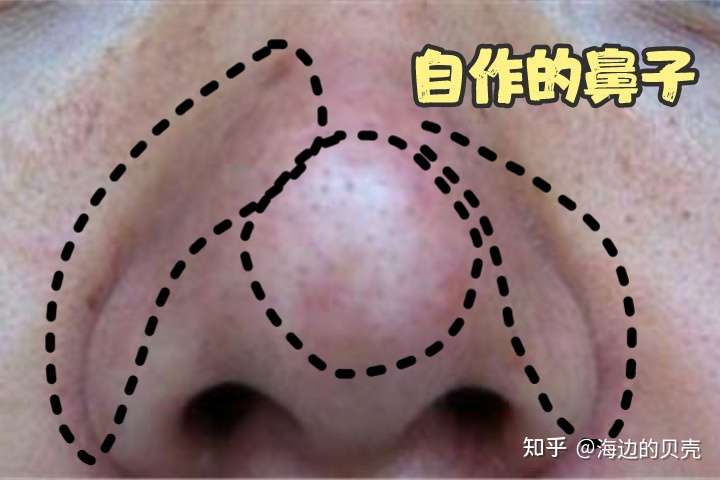严重成这样的草莓鼻怎么办啊!求救啊!