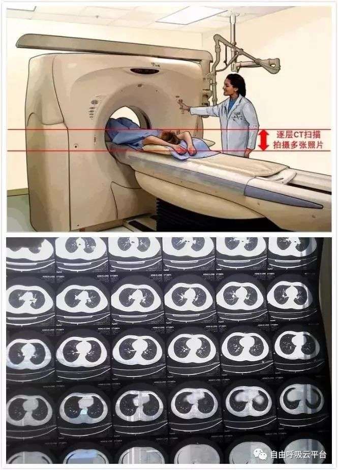 拿ct胶片报告或手机拍个照看看肺结节是不是癌