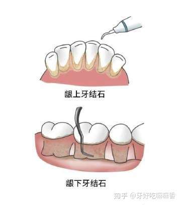 洗过牙了,为什么偏偏还要做龈下刮治 知乎