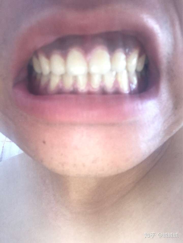牙龈呈暗紫色发黑是怎么回事啊?