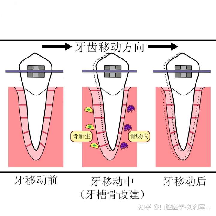 正畸中牙齿剧烈刺痛原因有哪些?