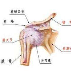 创伤等原因造成的肩关节周围组织的损伤,表现为肩部疼痛